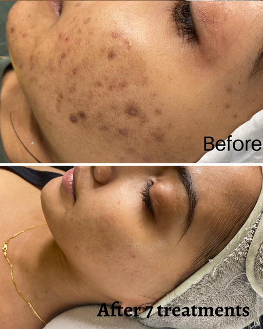 Say Goodbye To Acne Scars And Other Skin Issues With Chemical Peels