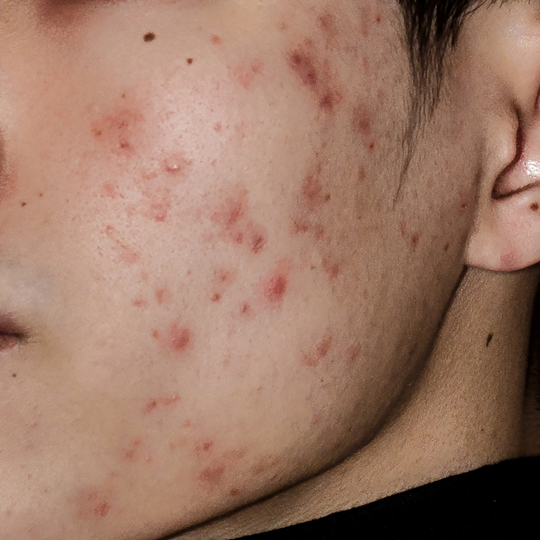 Mastering Acne Control: Moonskyn's Expert Insights